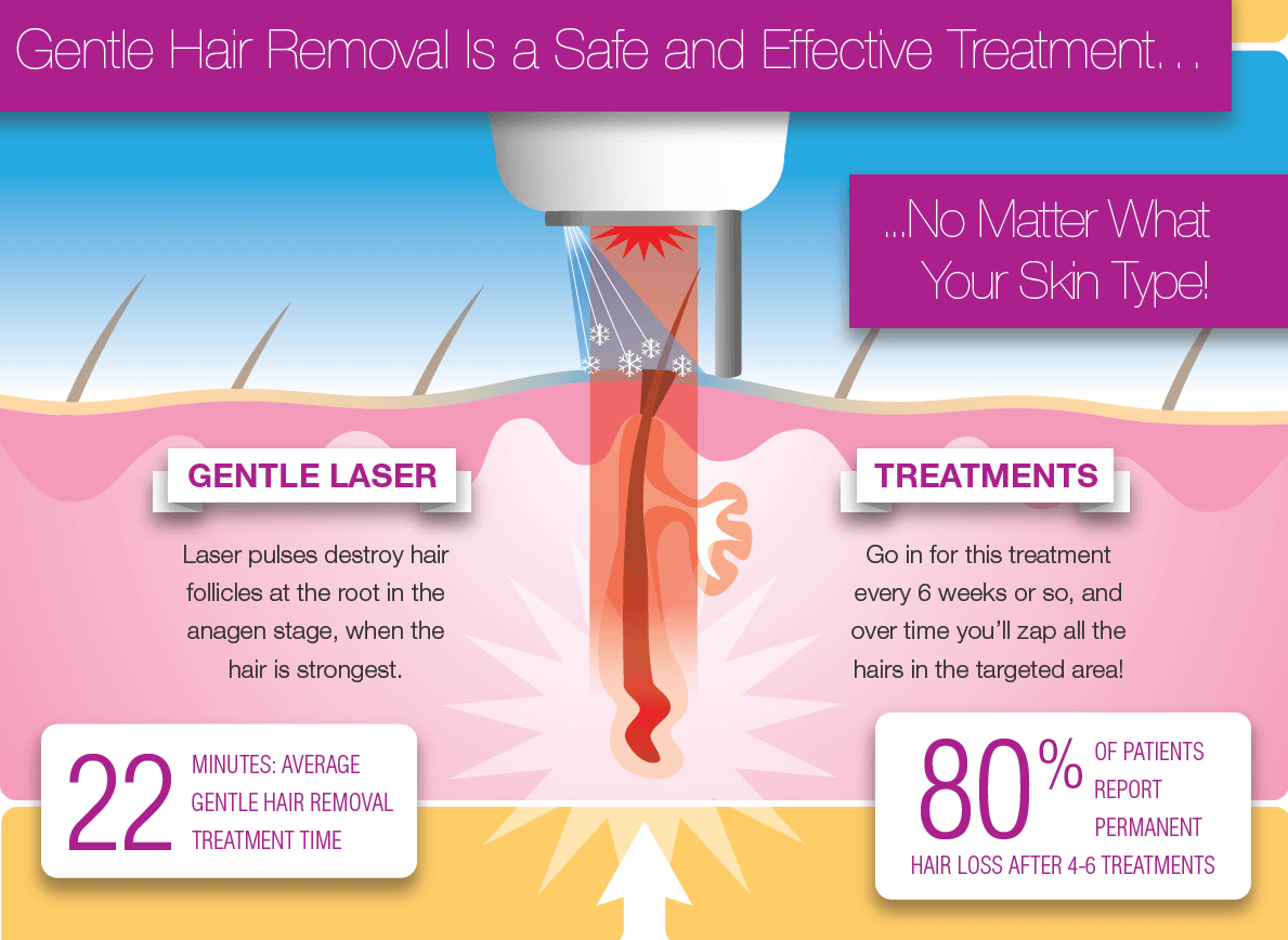 Laser Hair Removal InSkin Med Spa