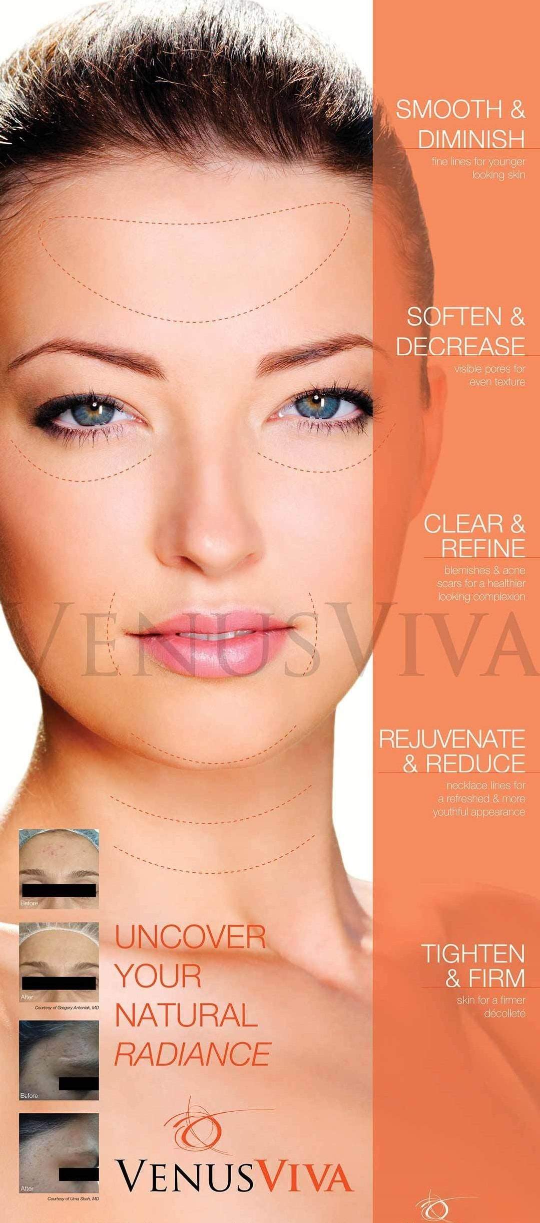 AgeLess InSkin Laser & Body Venus Viva Diamond Polar RF